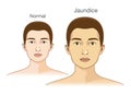 The Comparison between normal skin people and yellowing from Jaundice. Royalty Free Stock Photo