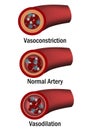 Comparison of normal, vasoconstriction and vasodilation blood vessels with cross section of arteries Royalty Free Stock Photo