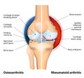 Comparison of Osteoarthritis and Rheumatoid Arthritis Royalty Free Stock Photo