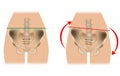 Comparison of pelvic distortion. Normal pelvis and distorted pelvis. Twisted Pelvis or Pelvic Torsion