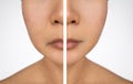 Nasolabial folds in a asian woman. Face close up. Before and after. Royalty Free Stock Photo