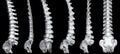 Comparison of Six Spine, Diverse Spinal Conditions and Postures Medical Illustration , Rendering Royalty Free Stock Photo