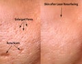 Comparison of skin before and after laser resurfacing. Skin with acne, acne scars, enlarged pores.