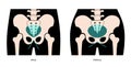 Muscular pelvis xray