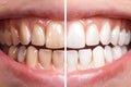 Before and after comparison of teeth whitening process with a focus on dental care Royalty Free Stock Photo