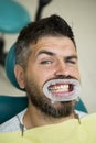 Comparison after teeth whitening. Teach patients about diets, flossing, the use of fluoride, and other aspects of dental Royalty Free Stock Photo