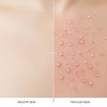 Healthy Skin vs. Papular Rash: Dermatological Diagnosis and Treatment Royalty Free Stock Photo