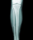 Complete fracture of the lower leg Royalty Free Stock Photo