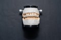 Complete full denture. Dental prosthesis design Royalty Free Stock Photo