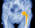 Complete hip implant surgery X-ray scan image of hip joints with orthopedic hip joint replacement  on left side implant head in Royalty Free Stock Photo