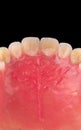 Complete maxillary denture Ã¢â¬â Wax-Up and Gingival Contouring