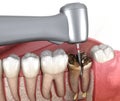 Complex tooth extraction. Medically accurate 3D illustration of dental treatment Royalty Free Stock Photo