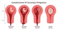 Complications of carrying a pregnancy. Miscarriage danger, separation