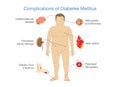 Complications of Diabetes Mellitus. Royalty Free Stock Photo