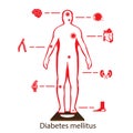 Complications of Diabetes Mellitus in fat people. Illustration in Infographic style about medical and health.