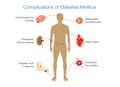 Complications of Diabetes Mellitus. Royalty Free Stock Photo