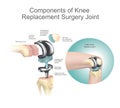 Components of knee replacement surgery joint. Royalty Free Stock Photo