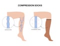 Compression stocking pressure