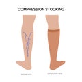 Compression stocking pressure Royalty Free Stock Photo