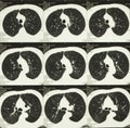 Computed body tomography of chest