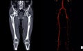 Computed tomography angiography CT angiography or CTA of lower extremities