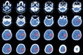 Computed tomography of the brain, hemorrhagic stroke.