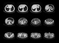 Computed tomography chest and abdomen