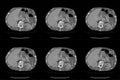 Computed tomography CT whole abdomen in Axial. Part fifteen