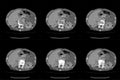 Computed tomography CT whole abdomen in Axial. Part nineteen