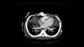 Computed Tomography of the pulmonary artery in Axial plane for diagnosis of pulmonary embolism