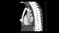 Computed Tomography of the pulmonary artery in Sagittal plane for diagnosis of pulmonary embolism