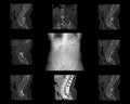 Computed tomography of the spine