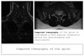 Computed tomography of the spine in a young man with a dorsal intervertebral hernia, diagnosis and detection of hernia, banner