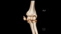 Computed Tomography Volume Rendering examination of the Elbow joint CT VR Elbow showing fracture of the medial epicondyle