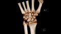 Computed Tomography Volume Rendering examination of the wrist joint CT VR wrist