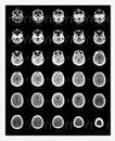 Computer axial tomography scan (CAT scan)