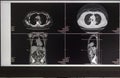 Computer Screen Showing MRI, CT Image Scan of the Brain. CT whole abdomen. Computer tomography scans in motion of lower and middle Royalty Free Stock Photo