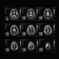 Computer tomography image of human brain regions. Black and white x-ray film