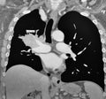 Computer tomography right mediastinal lymphoma