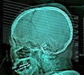 Computerized film x-ray tomography of human brain, CT Scan Royalty Free Stock Photo