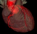 CT coronary angiography rendering