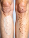 Concealing Varicose Veins with Leg Makeup Royalty Free Stock Photo