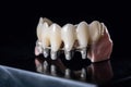 Concept for dental prosthesis. Demonstrating the placement of a dental implant on a close up model of teeth anatomy