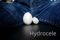 The concept of the disease hydrocele