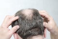 Concept of hair loss.Man doing a head massage as a treatment of receding Royalty Free Stock Photo