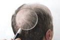 Concept of hair transplantation. Closeup of magnifying glass, exploring man`s back of head where is no hair Royalty Free Stock Photo