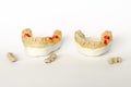 Concept of orthopedic dentistry. dental prosthetics with ceramic crowns and bridges. dental bridges on the posterior teeth.