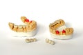 Concept of orthopedic dentistry. dental prosthetics with ceramic crowns and bridges. dental bridges on the posterior teeth. Royalty Free Stock Photo