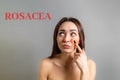 The concept of rosacea. A Caucasian brunette woman points a finger at a red cheek with inflammation. The inscription Rosacea. Copy