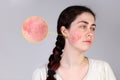 The concept of rosacea. A young Caucasian woman shows off a red cheek from rosacea. Copy space. The enlarged circle shows the